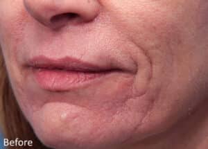 Genius Microneedling with RF