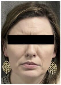 Botox
